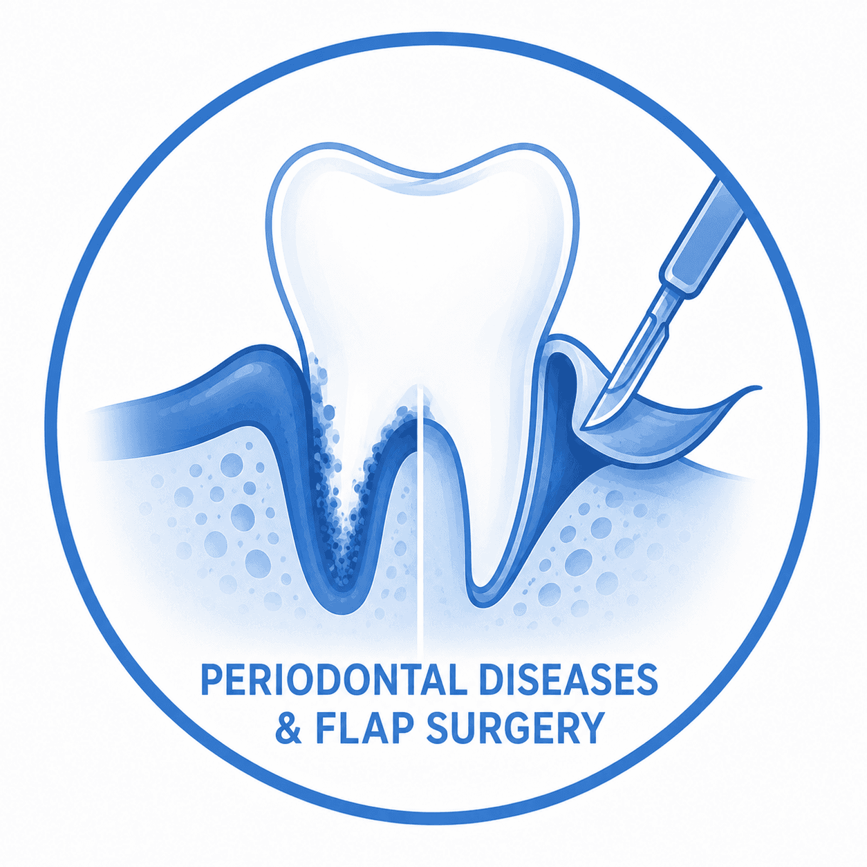 Periodontal Diseases & Flap / Advanced Gum Treatment