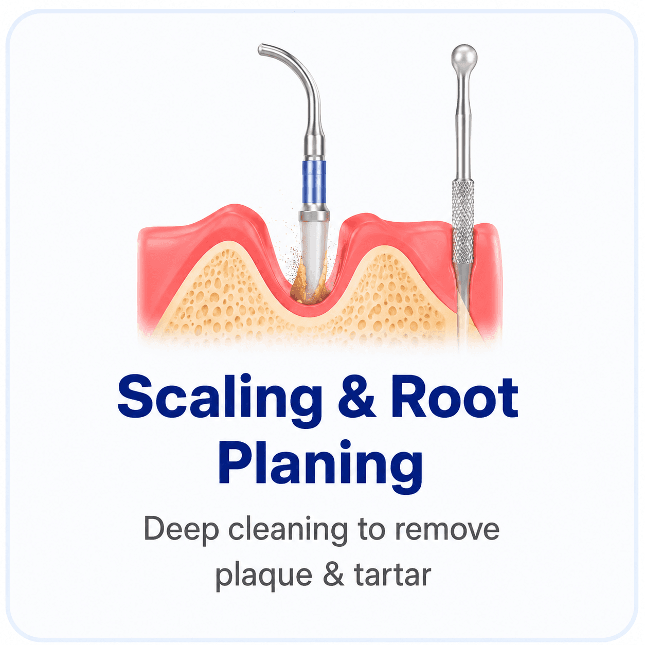 Scaling & Root Planing