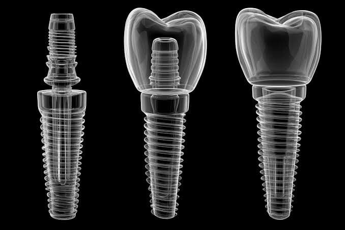 Busting 3 Common Myths About Dental Implants